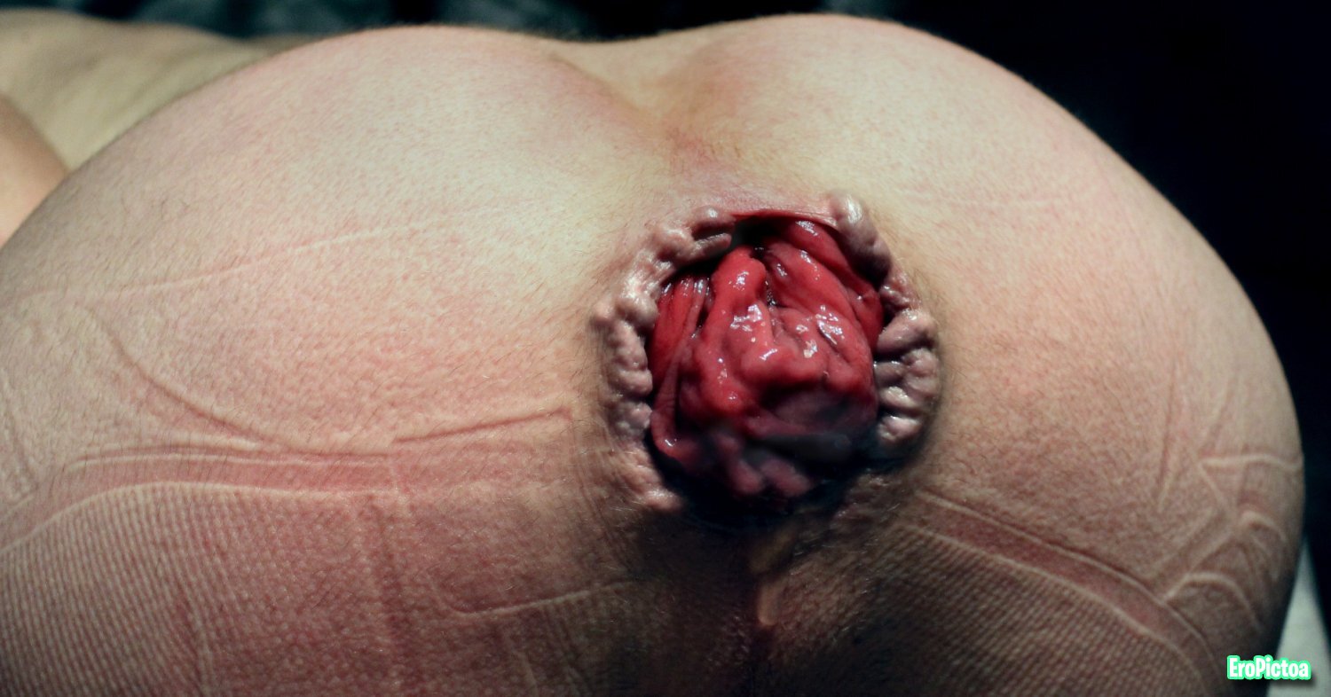 Prolapse art photo featuring extreme - Part 14